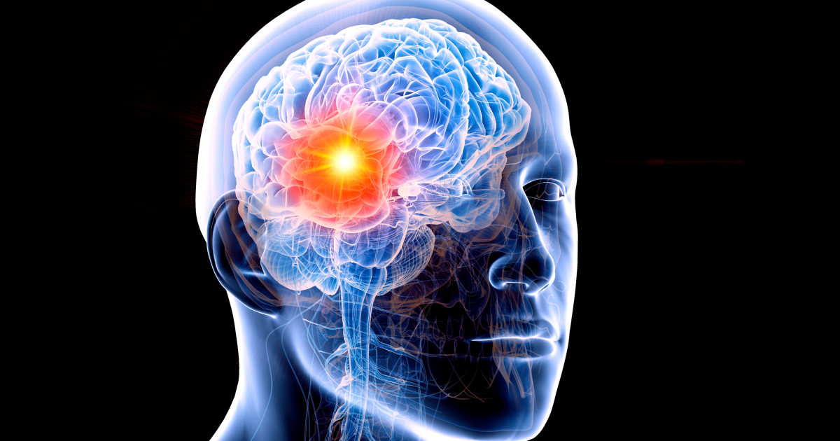 A neuro-oncologist at the Mayo Clinic reveals the telltale signs of a “classic brain tumor headache” and other brain tumor symptoms she looks for in her own body.