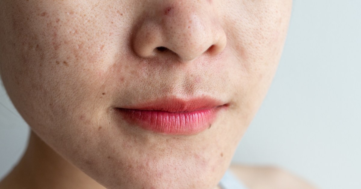 Skin Issues Can Signal Heart Problems. Here’s the No. 1 Sign to Watch For - TODAY.com
