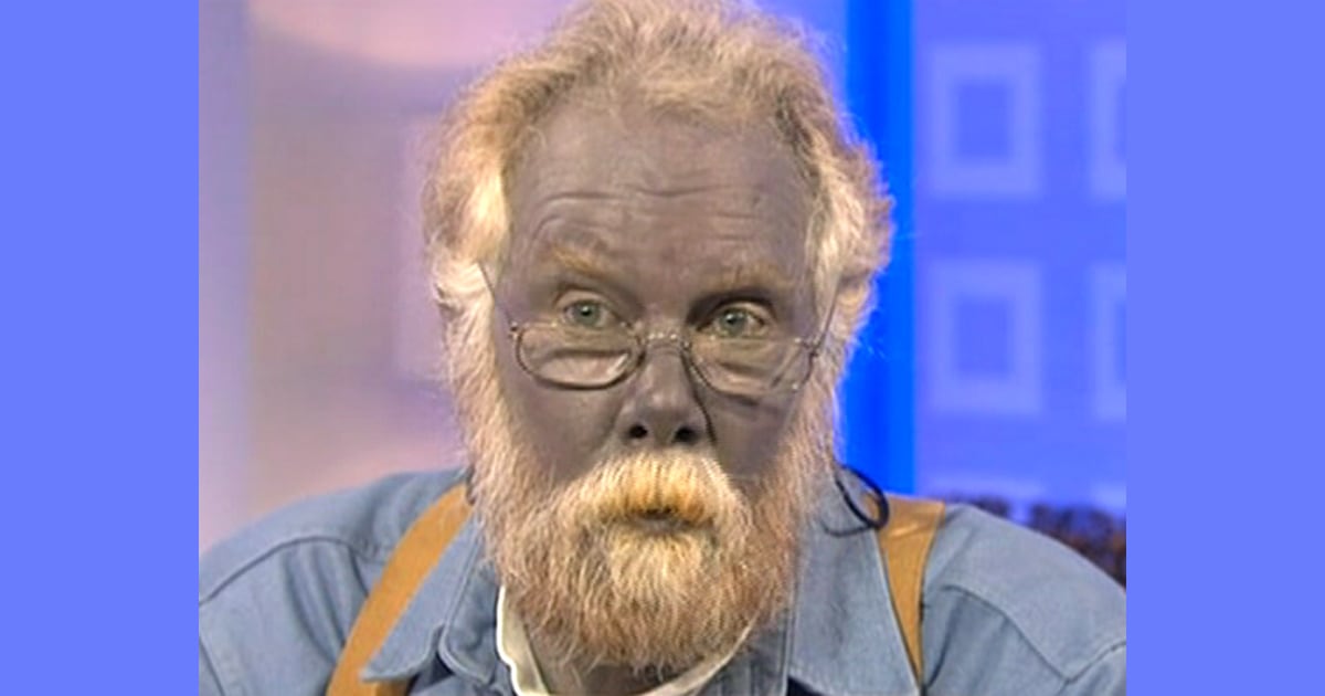 The real life Papa Smurf: Man turned himself BLUE after taking dietary  supplements for years